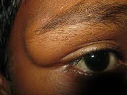 Angular Dermoid Angular Dermoid